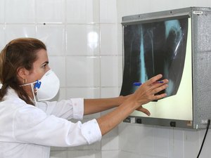 Cai o número de casos e mortes por tuberculose no Estado
