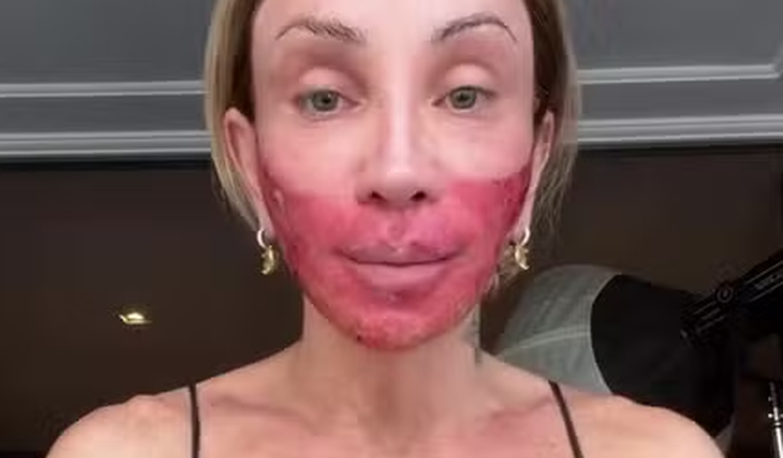 Com o rosto vermelho após novo peeling, Maya Massafera rebate críticas