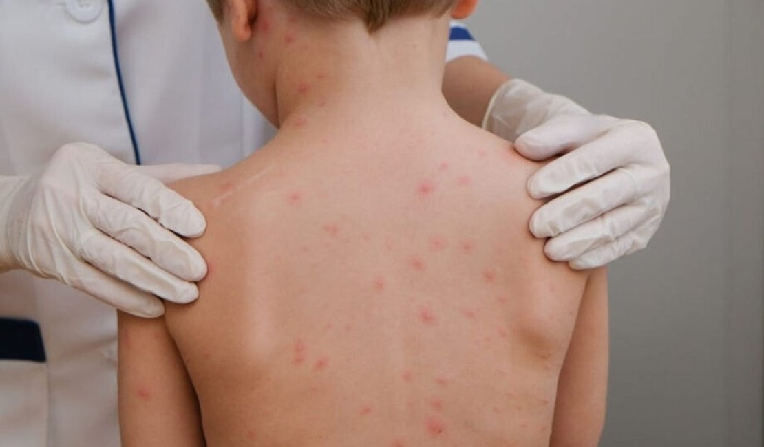 Alagoas lidera incidência de meningite no Nordeste e ocupa segunda posição no país