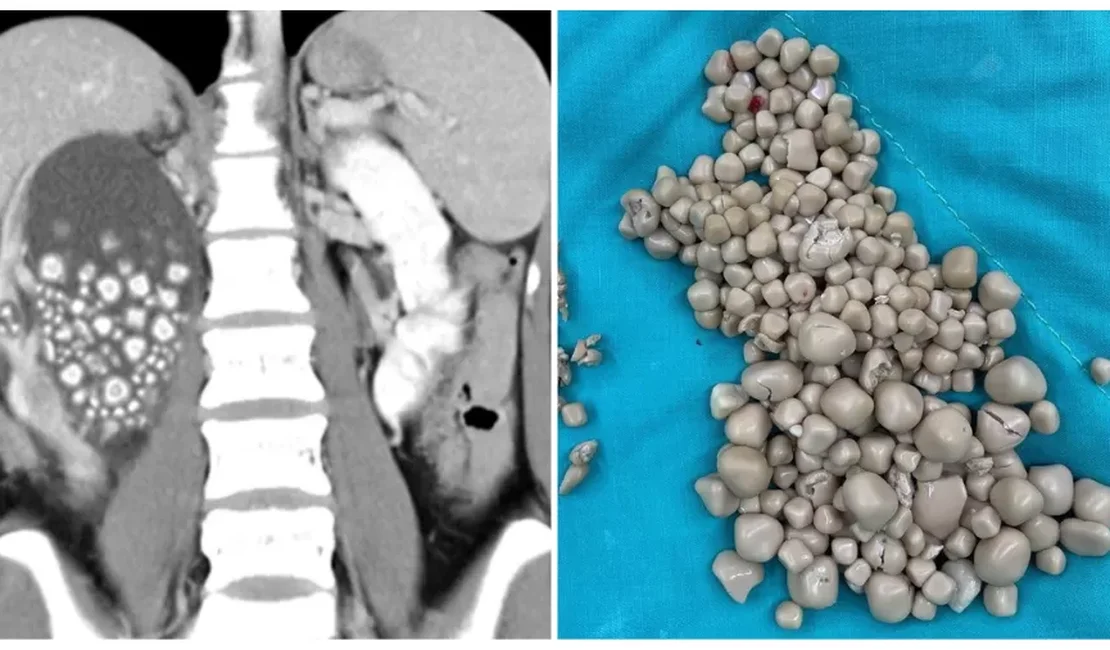 Médicos retiram mais de 300 pedras de rim de jovem de 20 anos em Taiwan