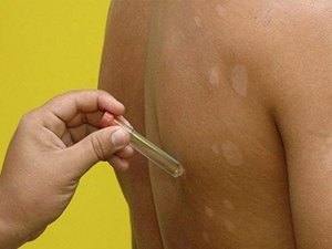 Portaria autoriza R$ 488 mil à campanha de combate à Hanseníase em AL