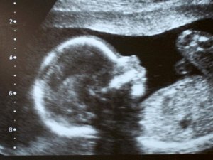 Em caso raro, menino nasce com dois pênis e sem ânus no Paquistão