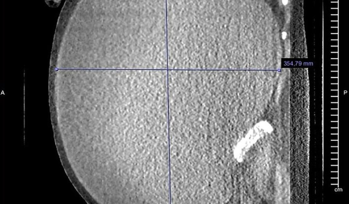 Mulher perde 53 kg após passar por cirurgia para remover cisto gigante