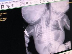 Gêmeas siamesas ligadas pelo tronco morrem em São Paulo