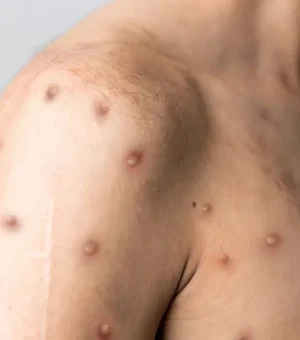 Mpox chega a 81 casos no Brasil em 2026; veja sintomas e quando suspeitar