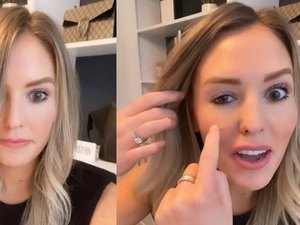 Botox de influenciadora dá errado e chama atenção na internet