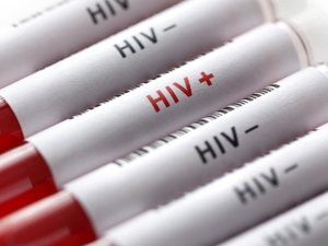 Aids: da epidemia mundial ao tratamento gratuito no Brasil