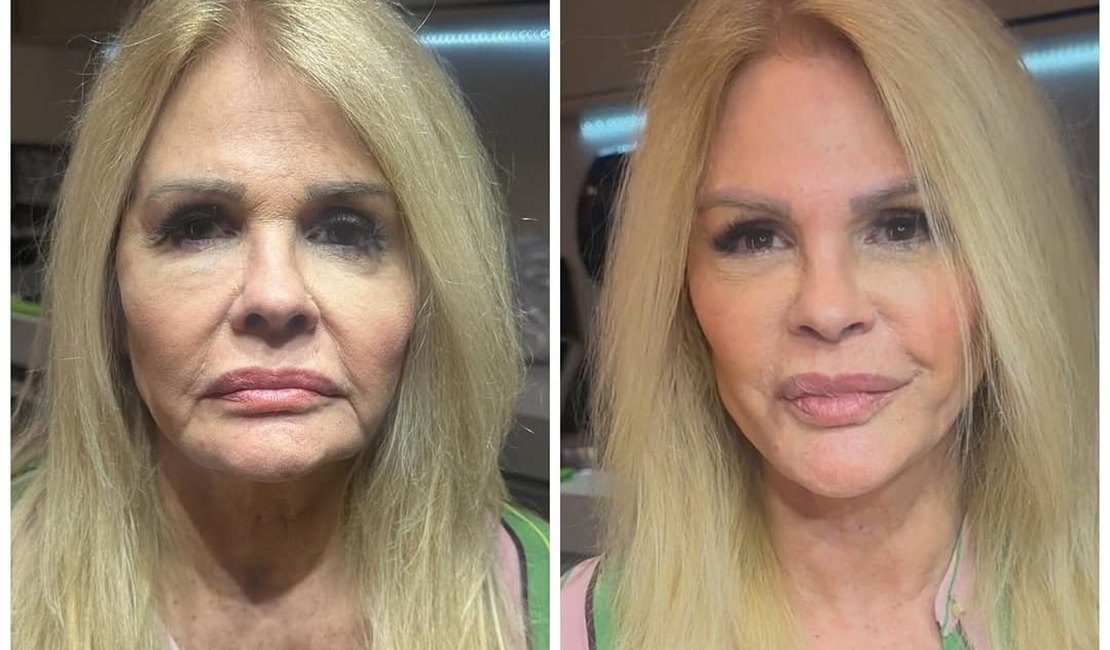 Monique Evans festeja resultado de harmonização facial: 'Ele fez milagre'