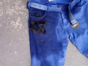 Enfermeiro tem queimadura na perna após celular explodir no bolso da calça